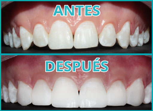 Diseño de Sonrisa