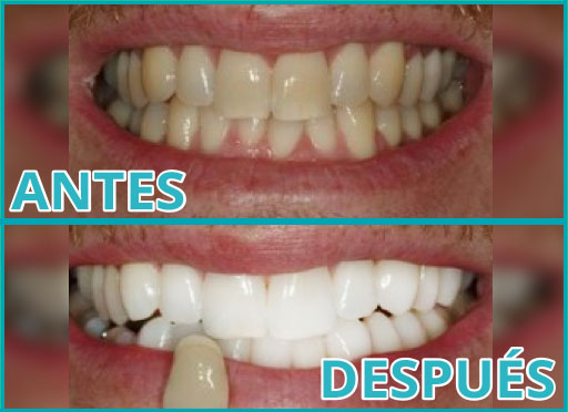 Aclaramiento Dental Total