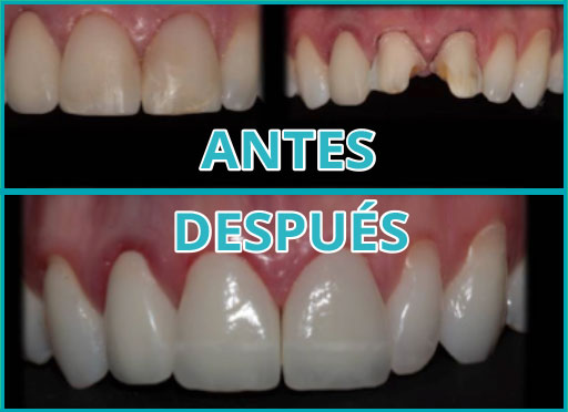 Carillas en cerámica